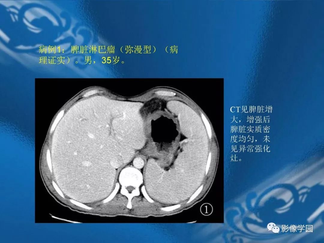 【PPT】脾脏病变大汇集