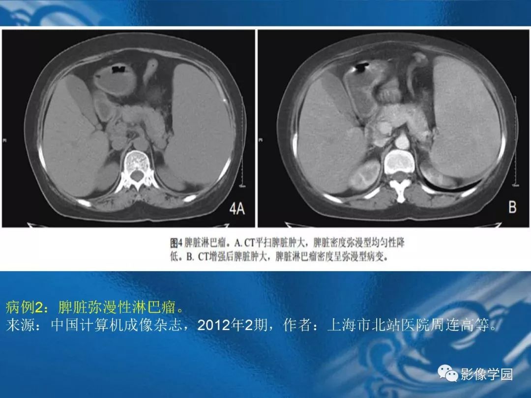 【PPT】脾脏病变大汇集
