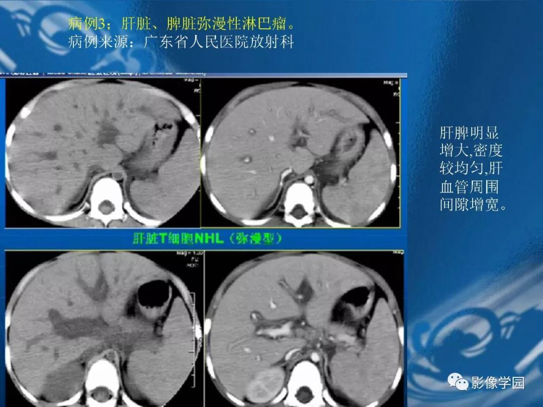 【PPT】脾脏病变大汇集