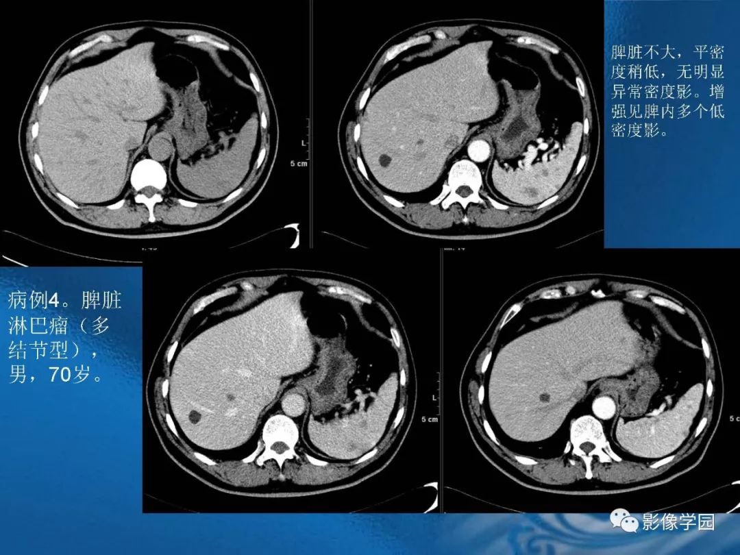 【PPT】脾脏病变大汇集