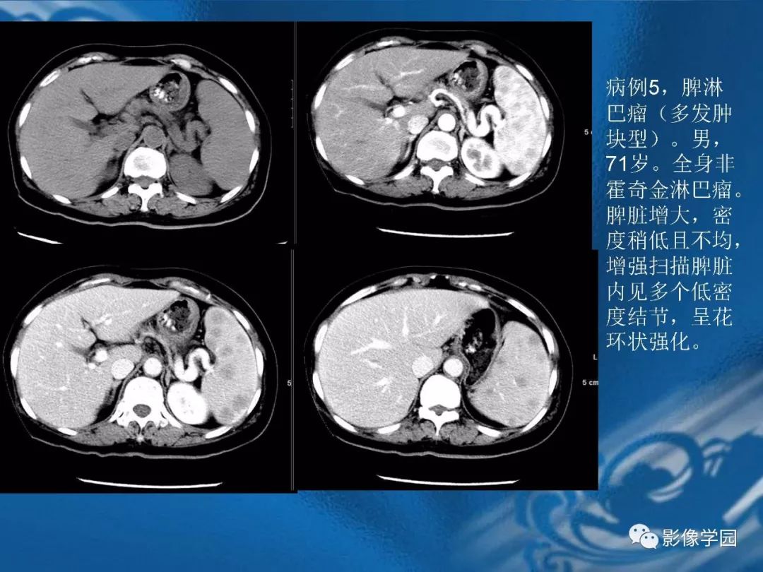 【PPT】脾脏病变大汇集
