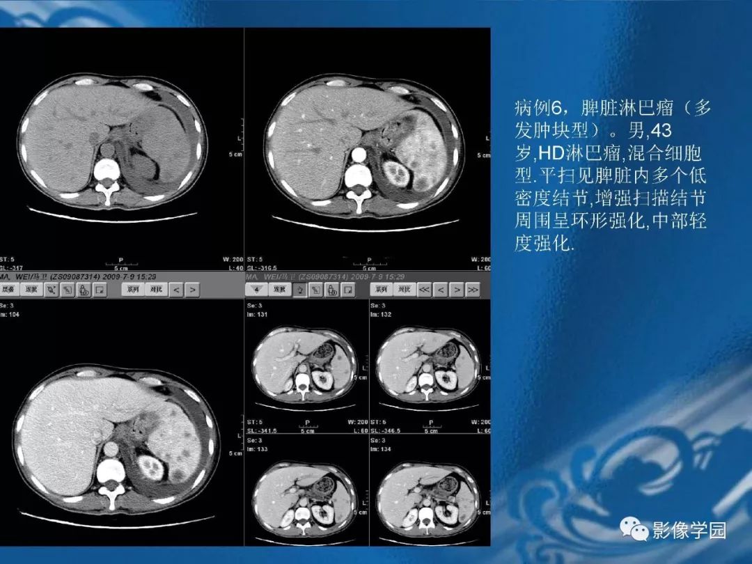 【PPT】脾脏病变大汇集