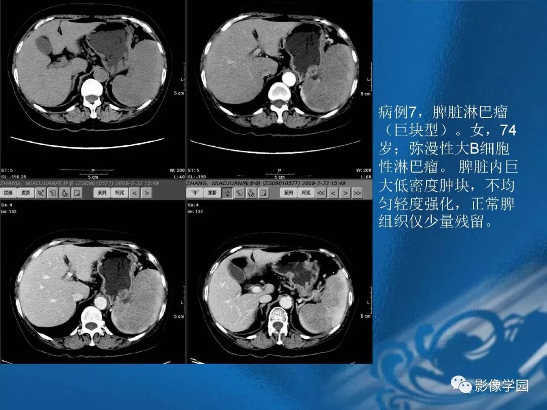 【PPT】脾脏病变大汇集
