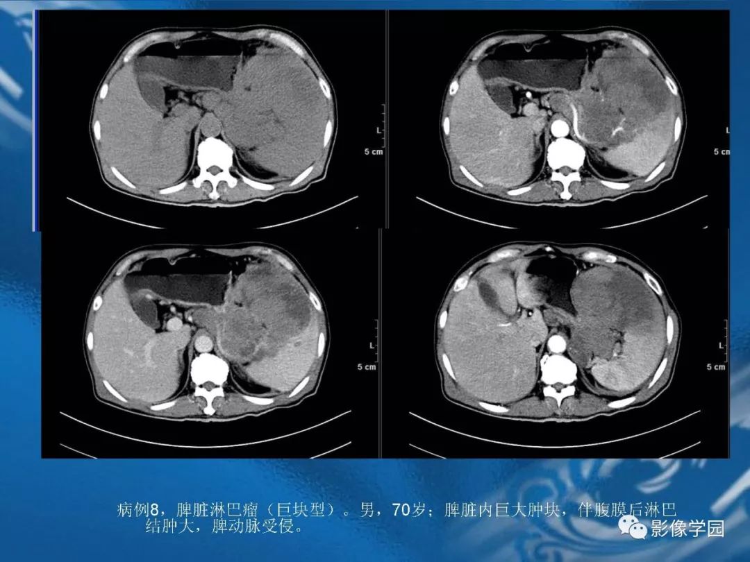 【PPT】脾脏病变大汇集