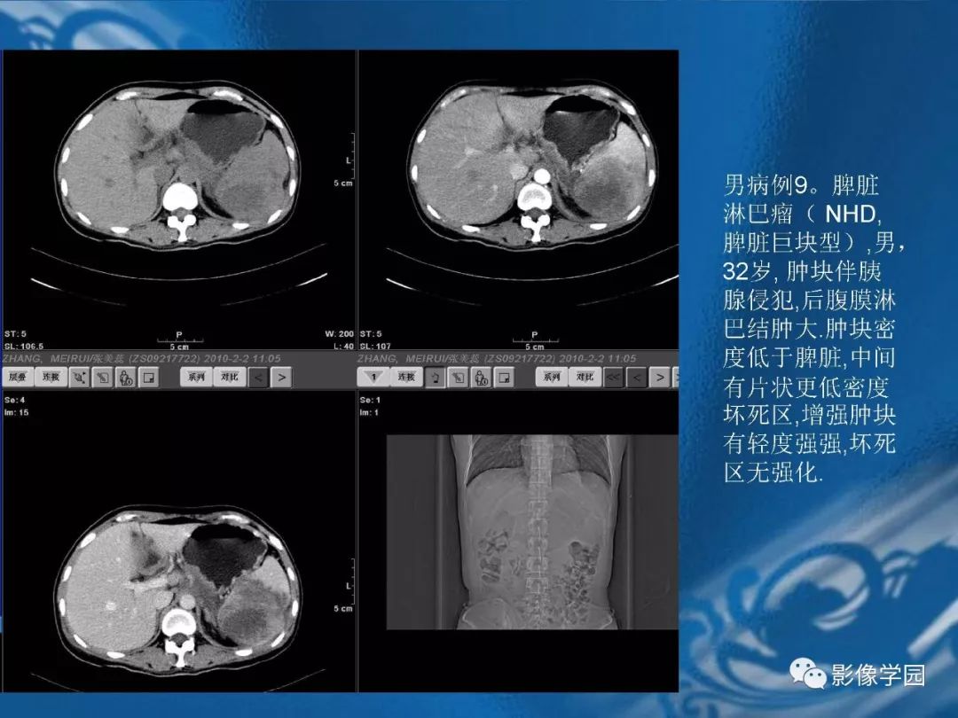 【PPT】脾脏病变大汇集