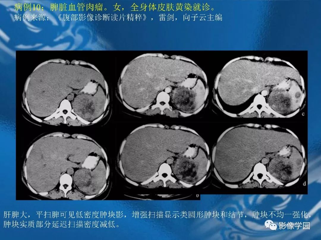 【PPT】脾脏病变大汇集