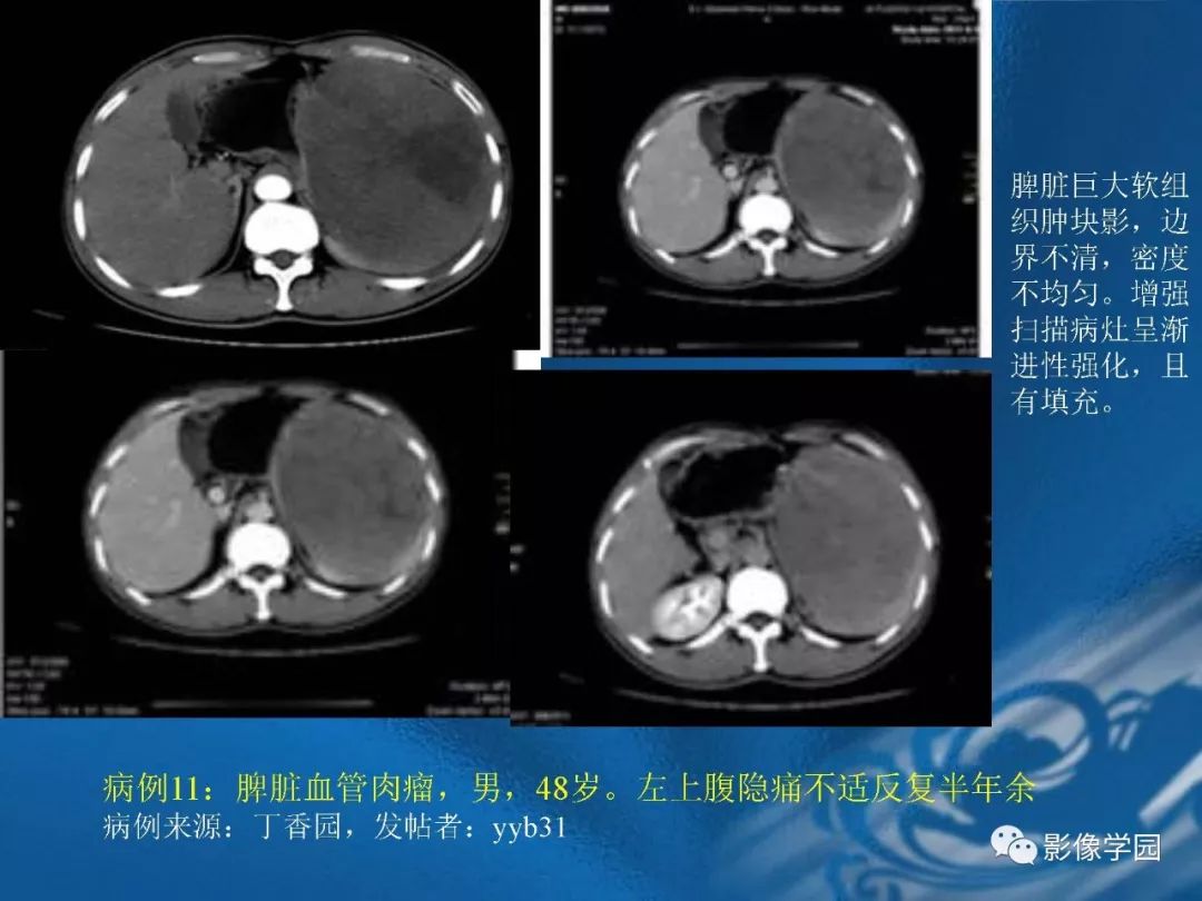 【PPT】脾脏病变大汇集