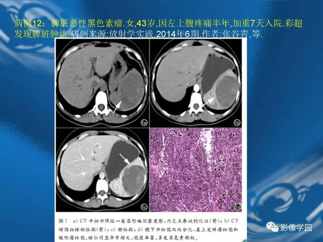 【PPT】脾脏病变大汇集