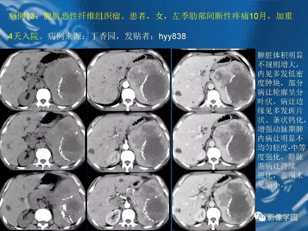 【PPT】脾脏病变大汇集
