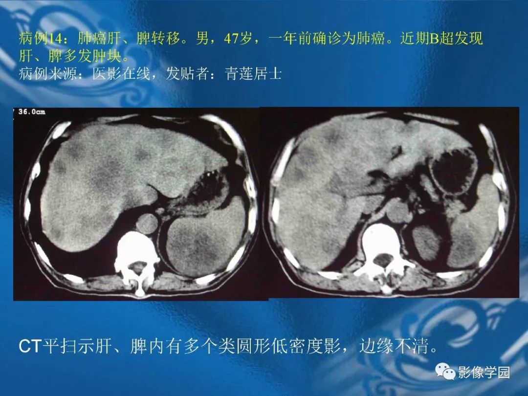 【PPT】脾脏病变大汇集