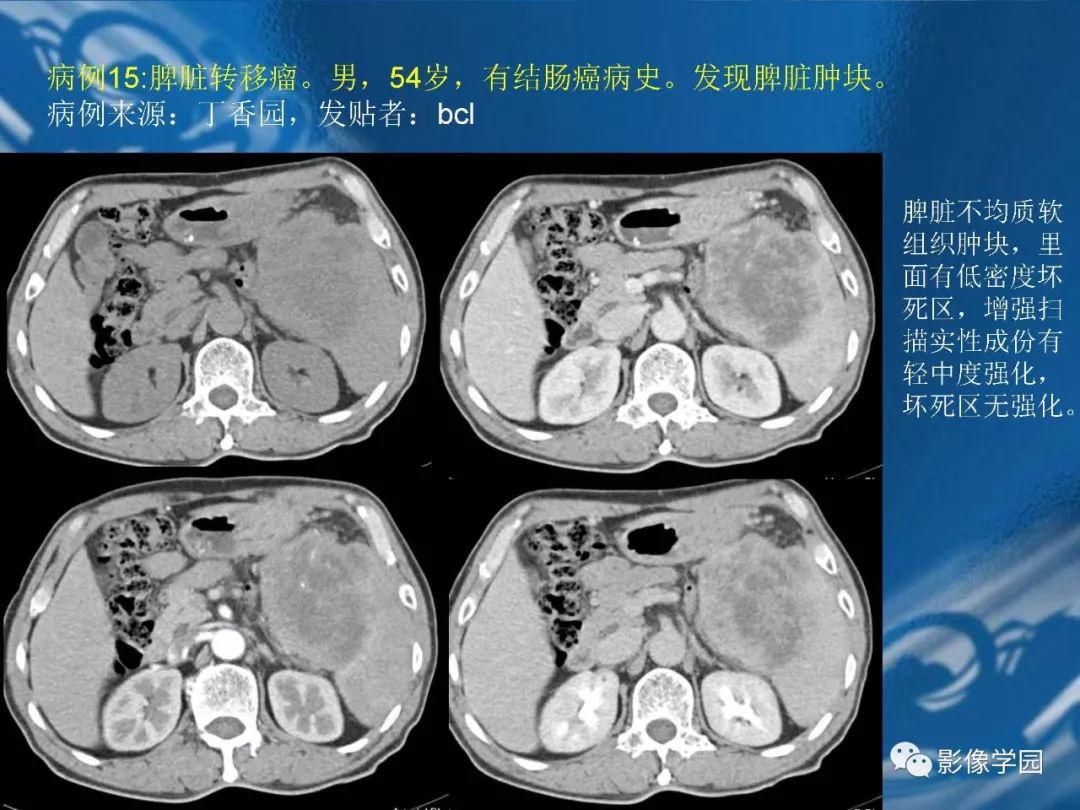 【PPT】脾脏病变大汇集