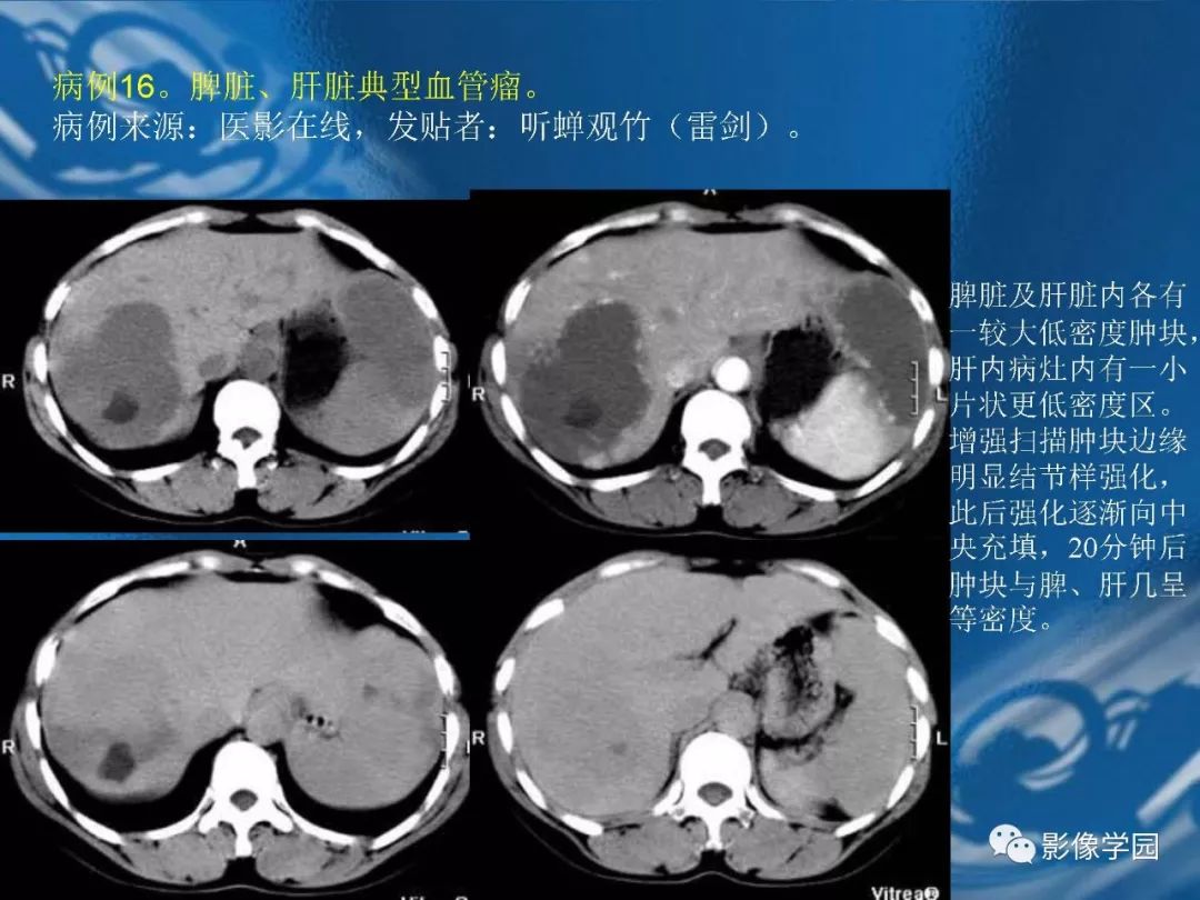 【PPT】脾脏病变大汇集