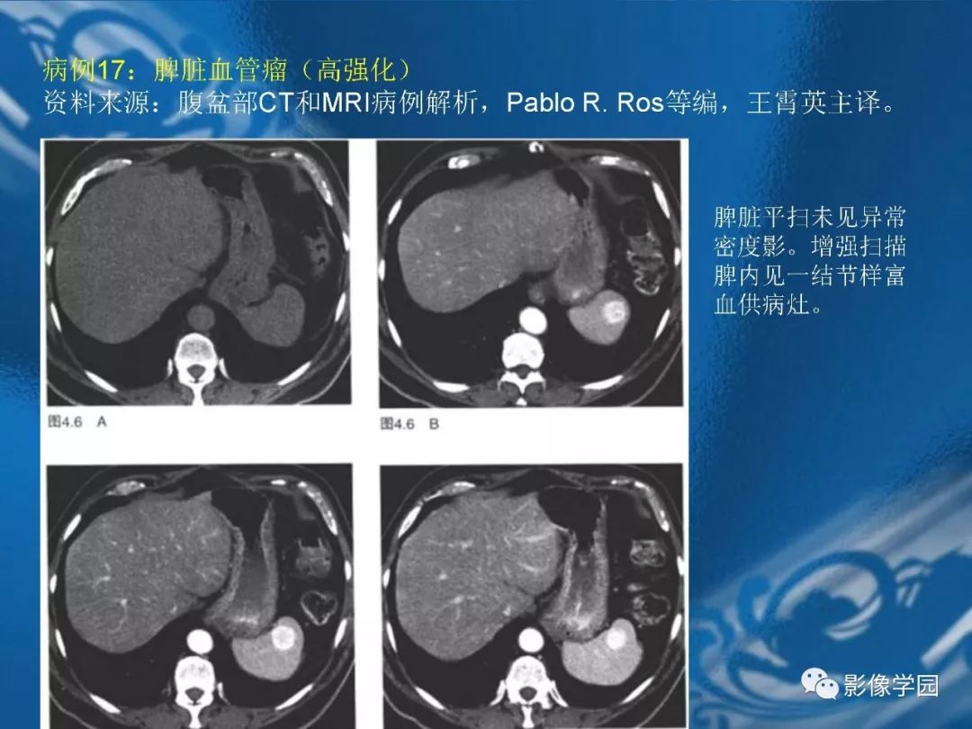 【PPT】脾脏病变大汇集