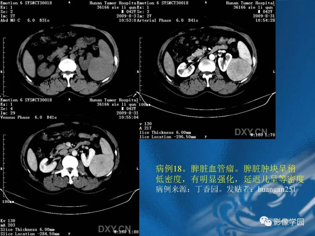 【PPT】脾脏病变大汇集