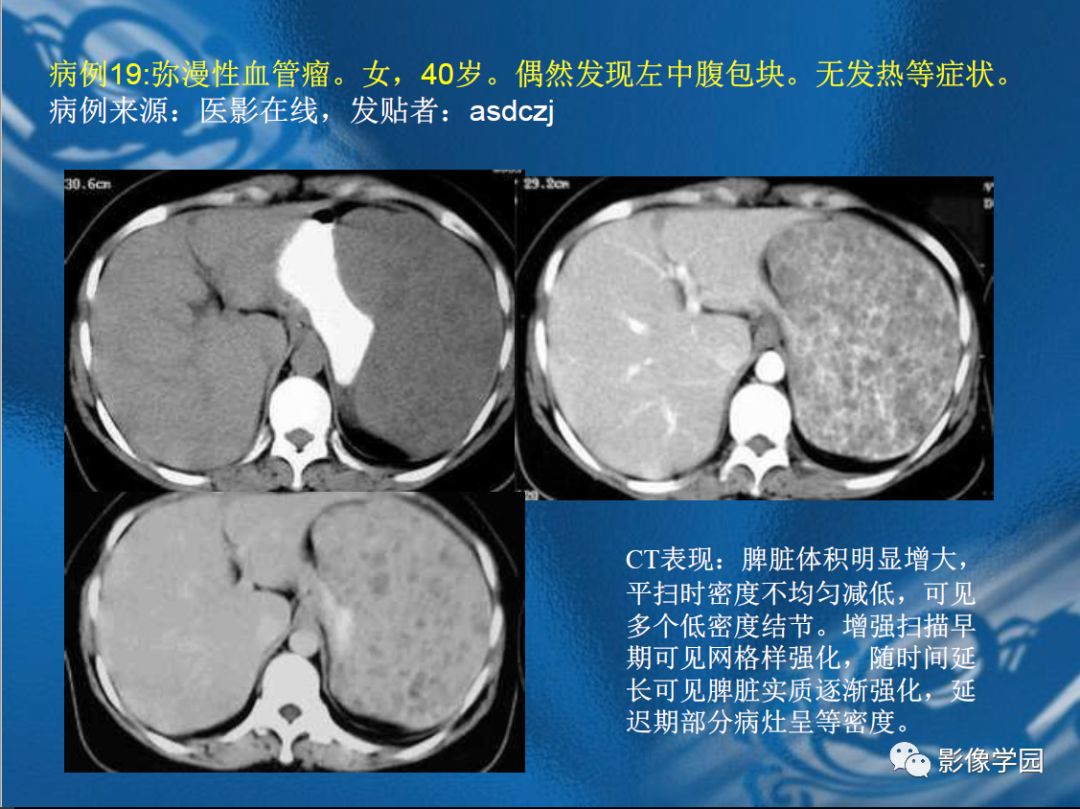【PPT】脾脏病变大汇集