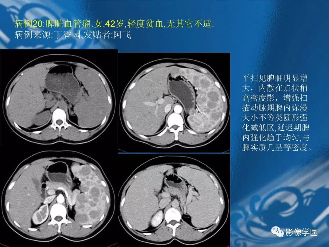 【PPT】脾脏病变大汇集