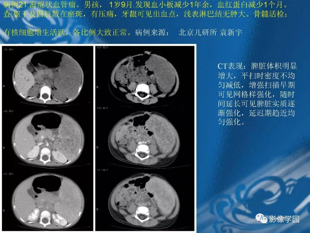 【PPT】脾脏病变大汇集