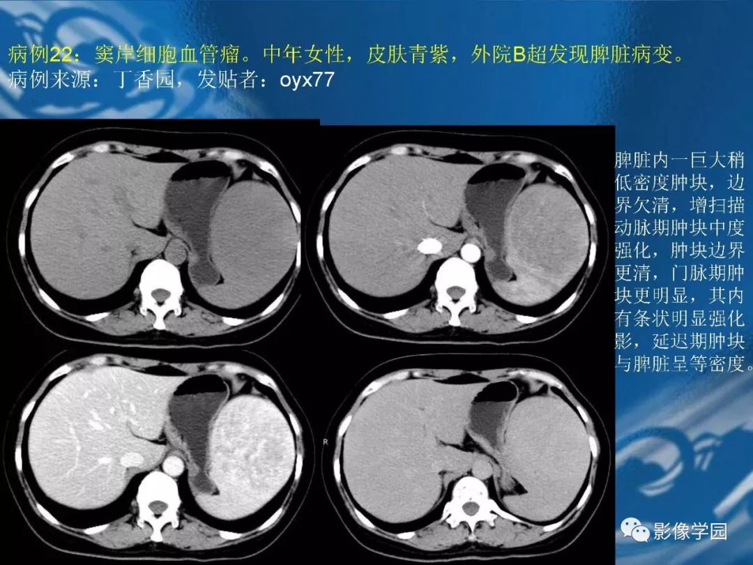 【PPT】脾脏病变大汇集