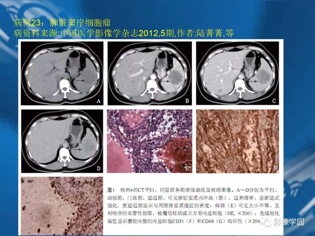 【PPT】脾脏病变大汇集