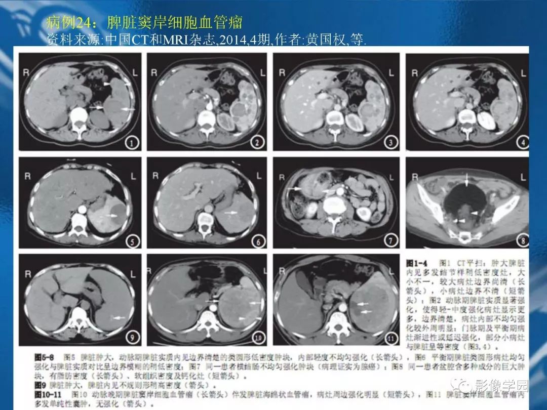 【PPT】脾脏病变大汇集