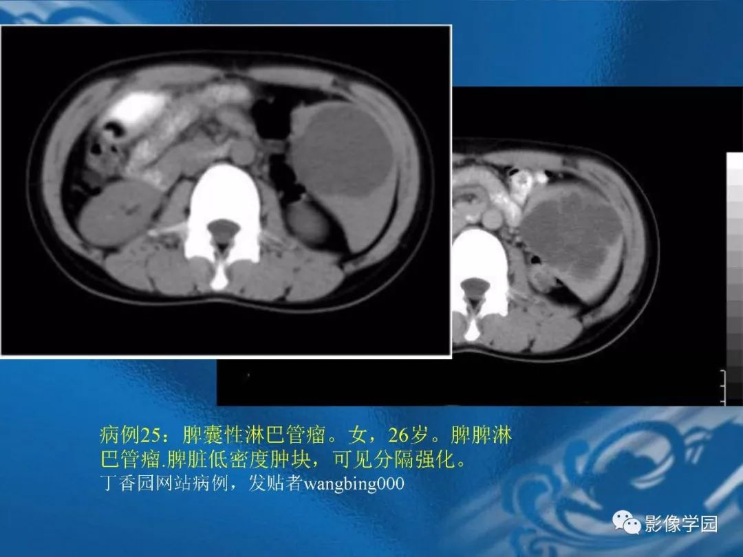 【PPT】脾脏病变大汇集