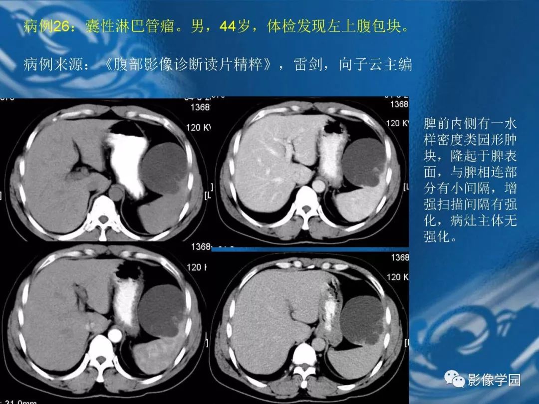 【PPT】脾脏病变大汇集