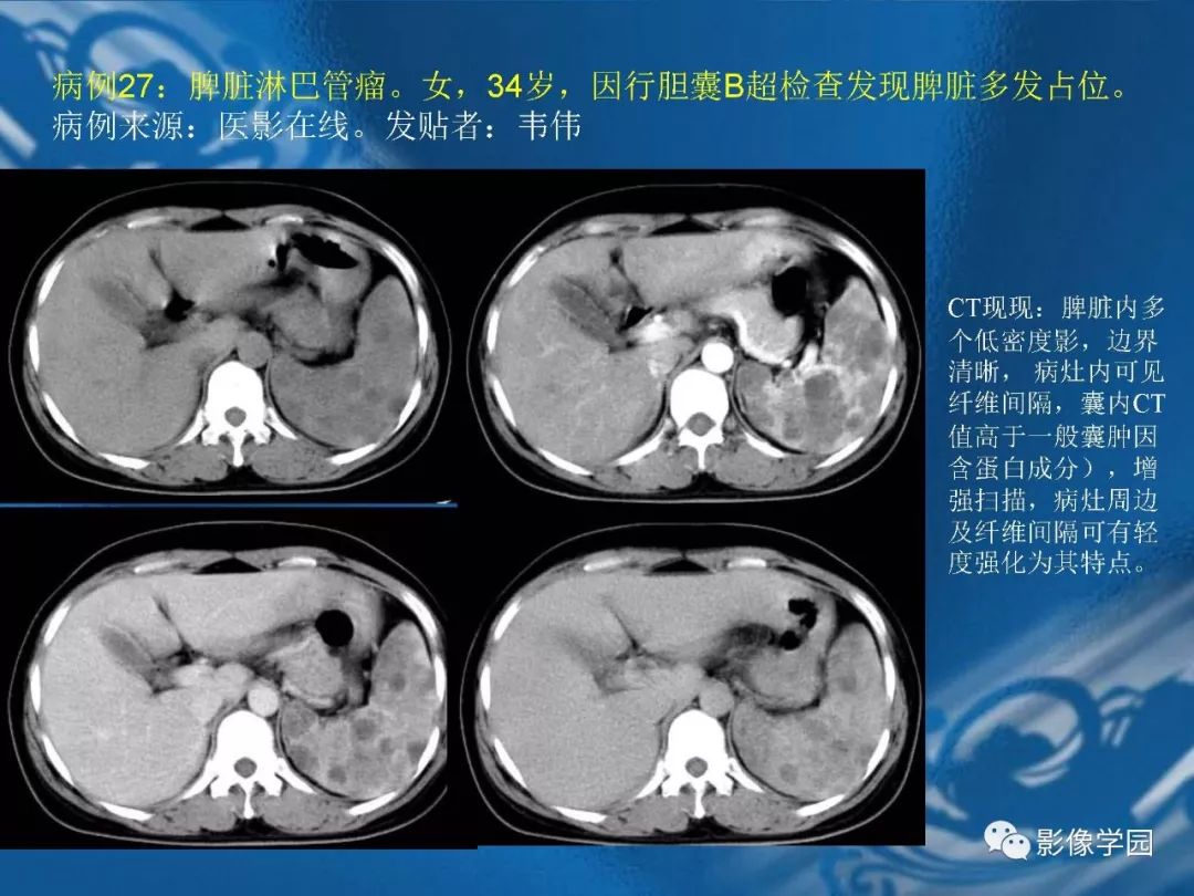 【PPT】脾脏病变大汇集