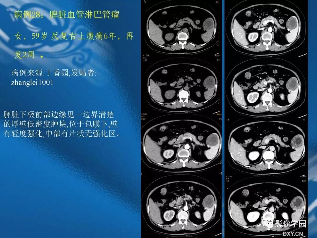 【PPT】脾脏病变大汇集