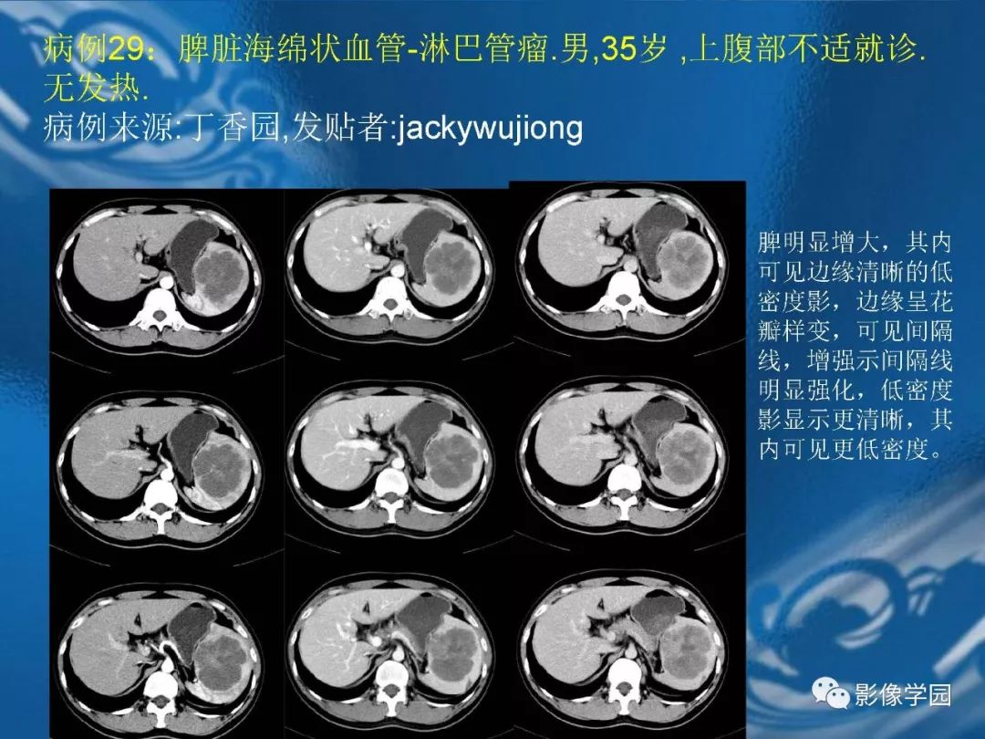 【PPT】脾脏病变大汇集
