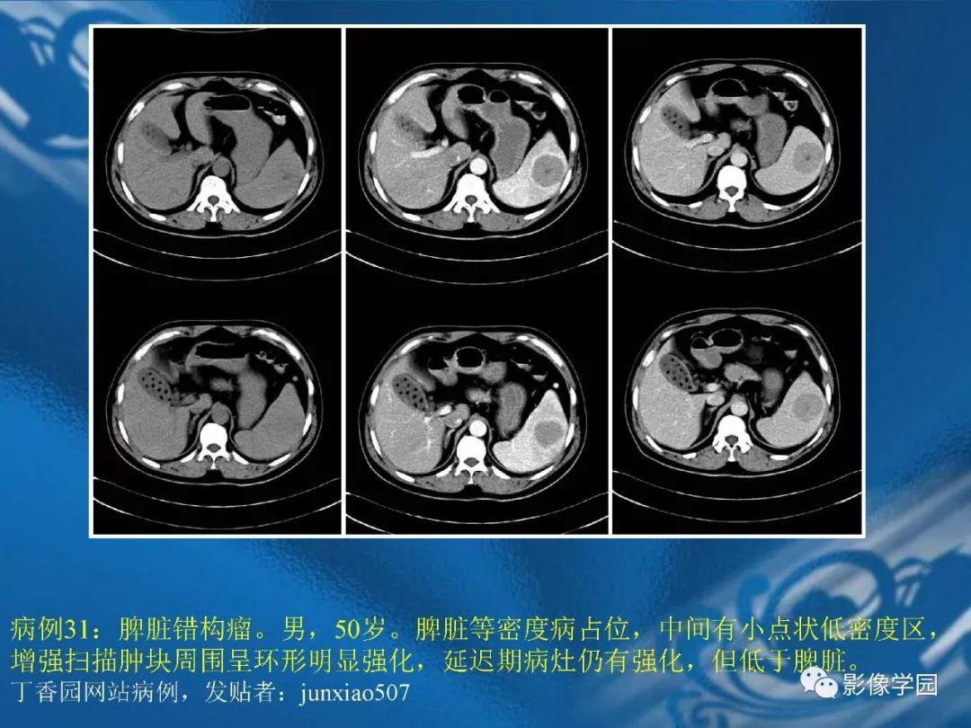 【PPT】脾脏病变大汇集