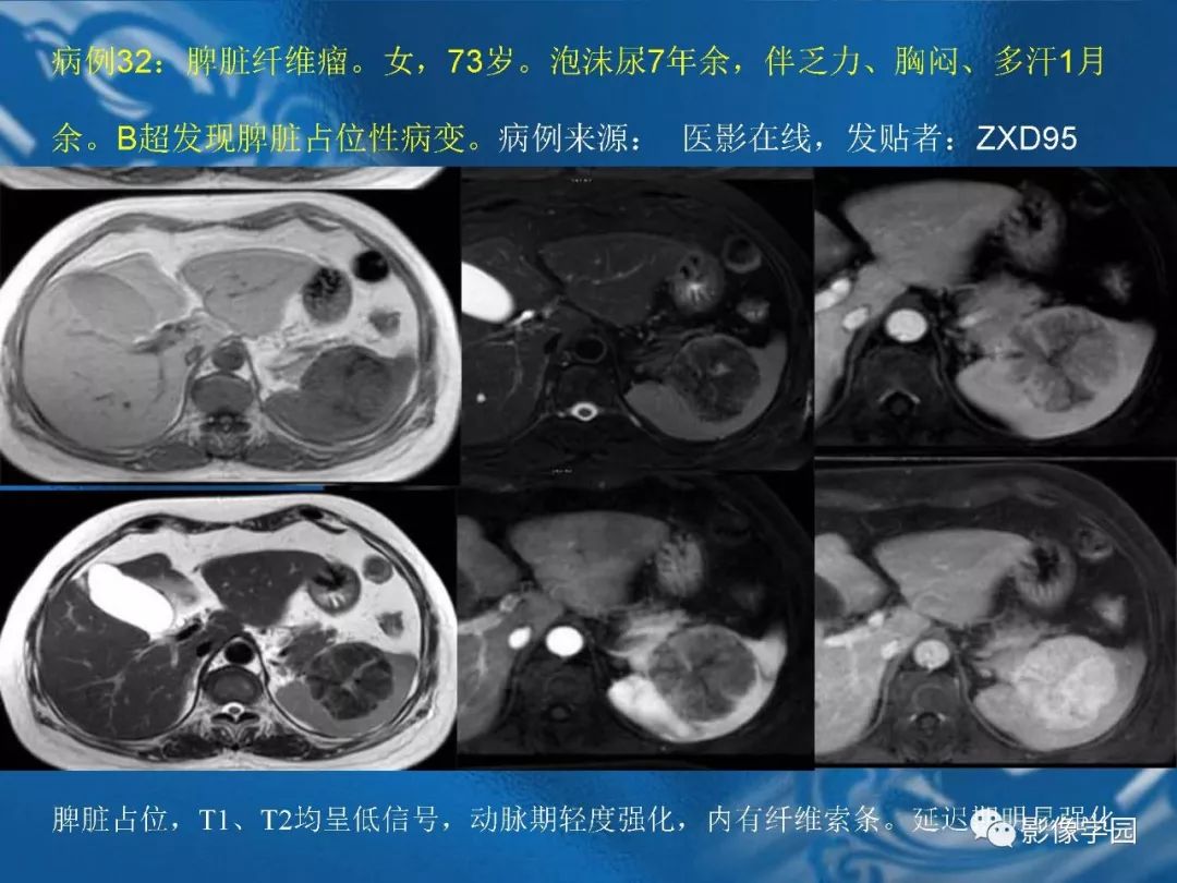 【PPT】脾脏病变大汇集