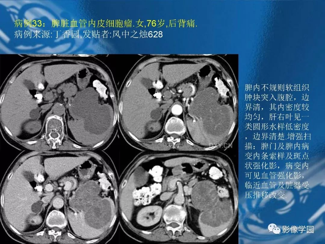 【PPT】脾脏病变大汇集
