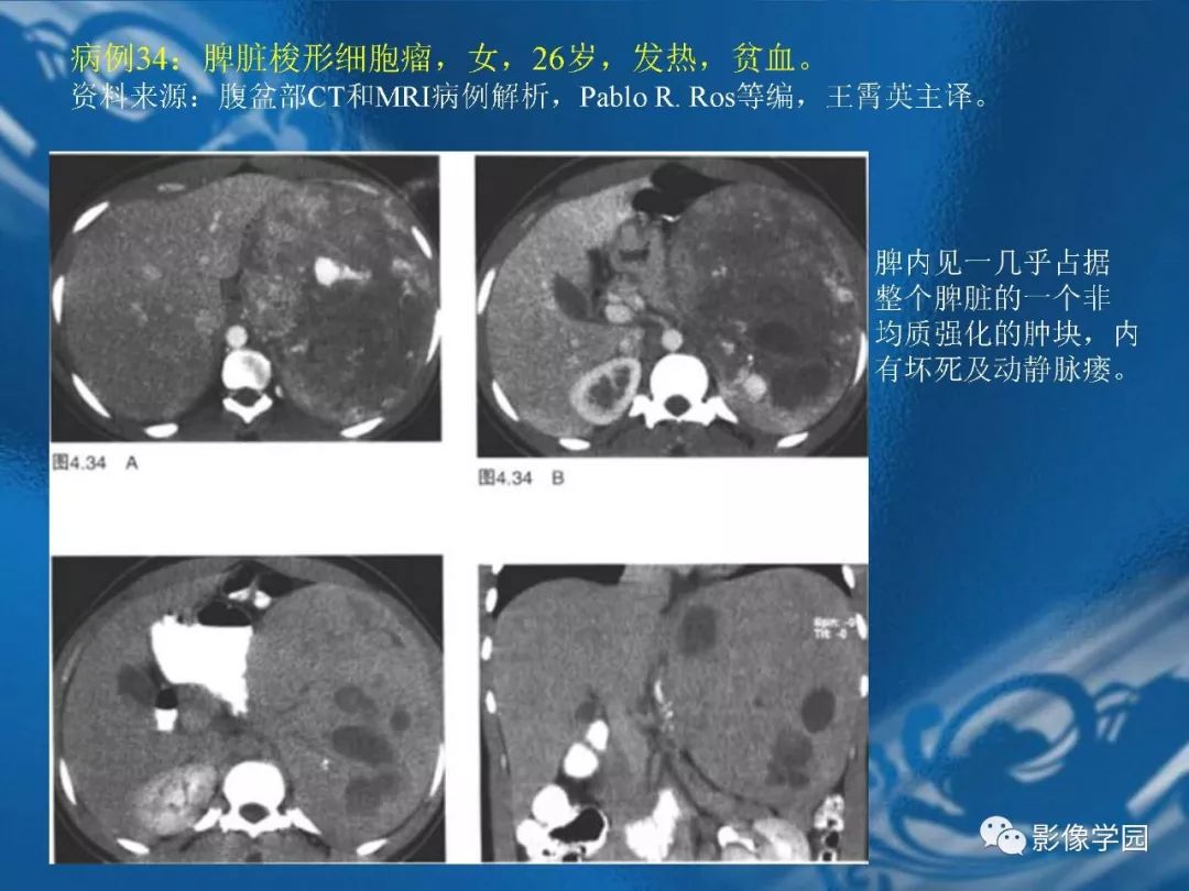 【PPT】脾脏病变大汇集