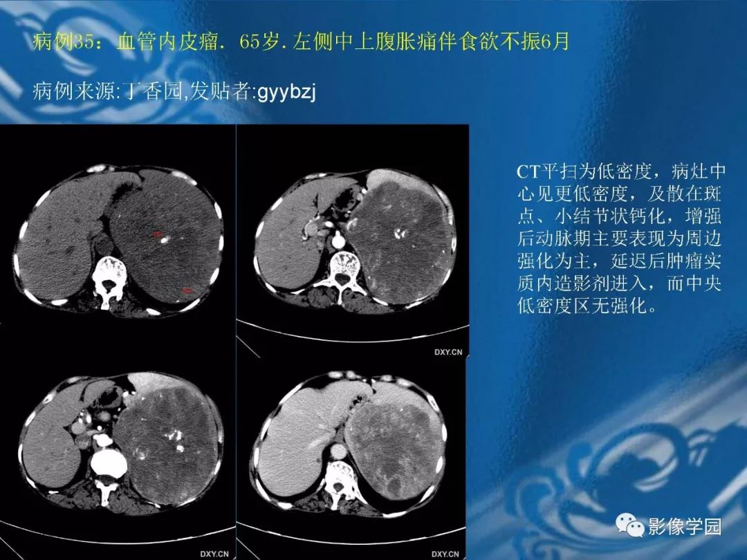【PPT】脾脏病变大汇集