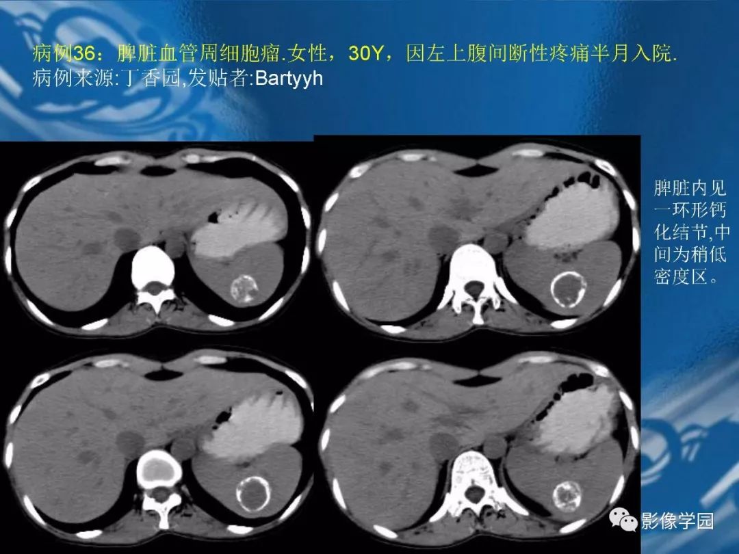 【PPT】脾脏病变大汇集