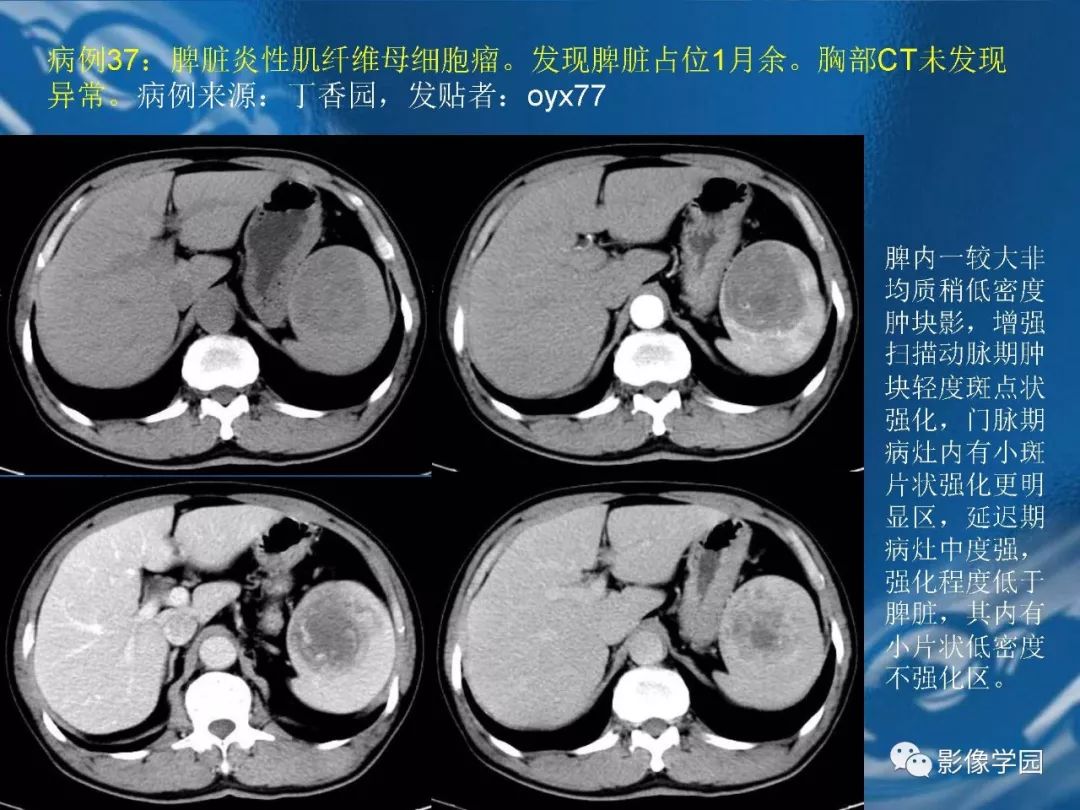 【PPT】脾脏病变大汇集