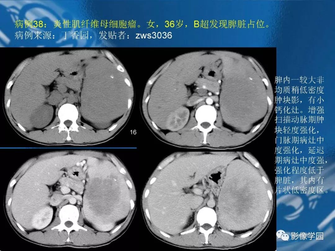【PPT】脾脏病变大汇集