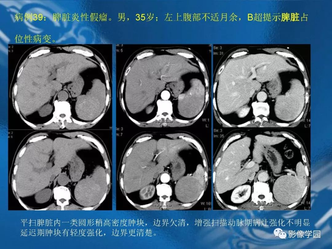 【PPT】脾脏病变大汇集
