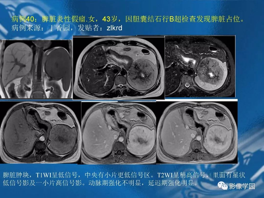 【PPT】脾脏病变大汇集
