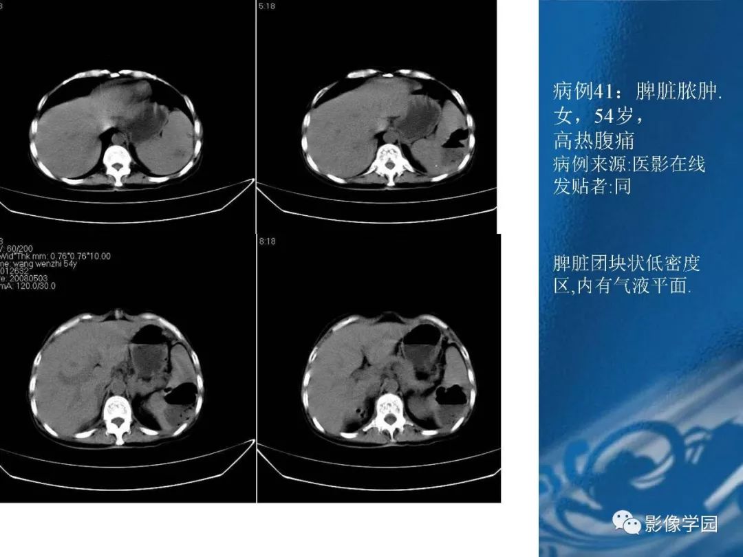 【PPT】脾脏病变大汇集
