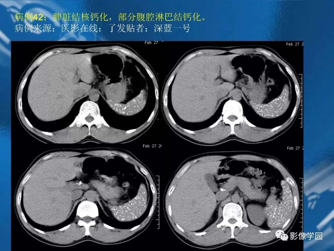 【PPT】脾脏病变大汇集