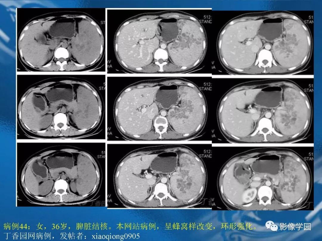 【PPT】脾脏病变大汇集