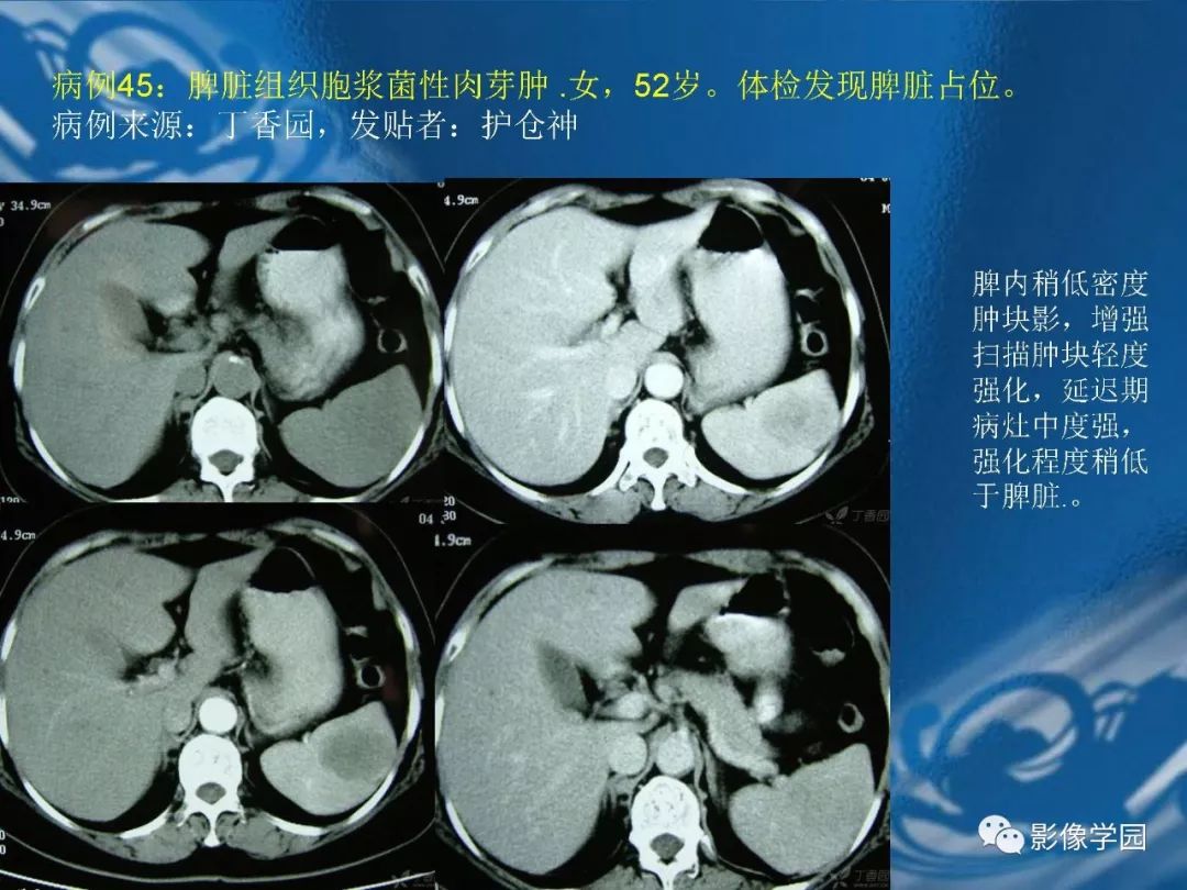 【PPT】脾脏病变大汇集