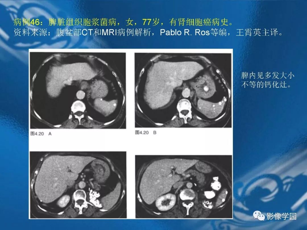 【PPT】脾脏病变大汇集