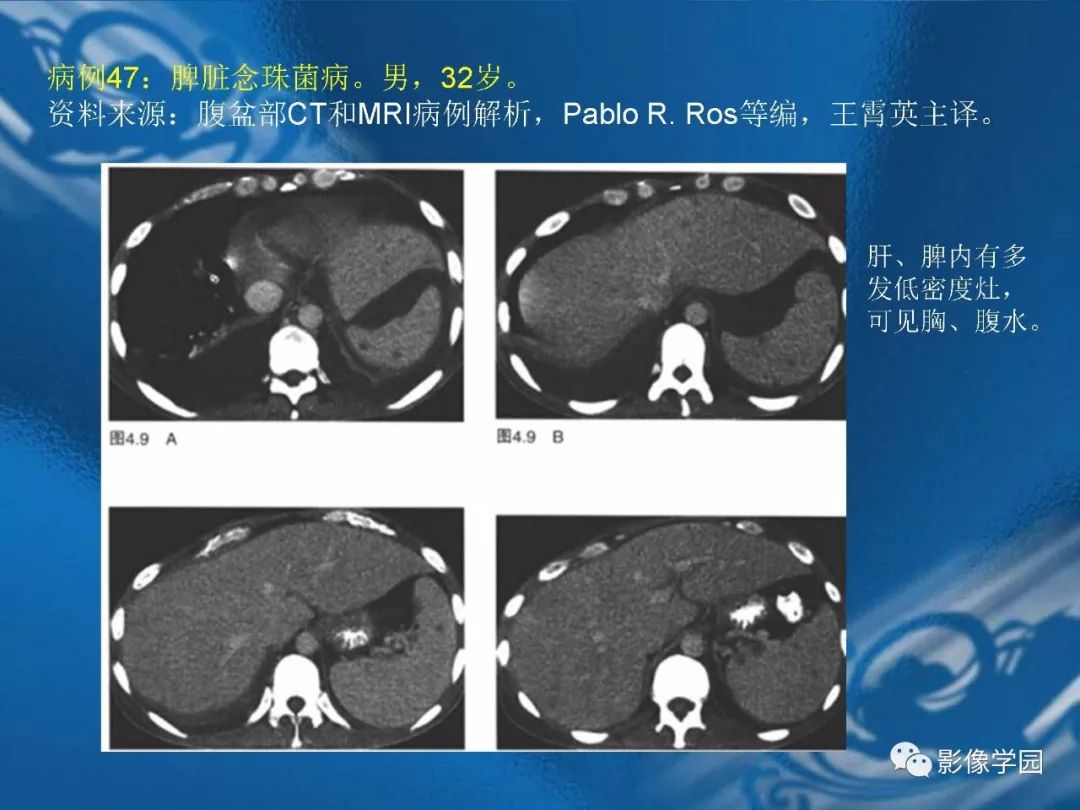 【PPT】脾脏病变大汇集