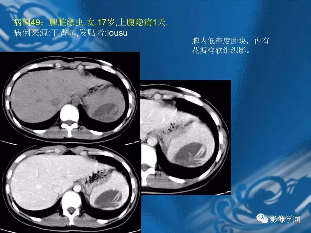 【PPT】脾脏病变大汇集