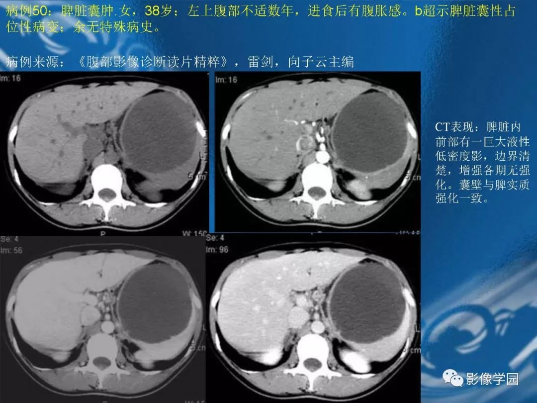 【PPT】脾脏病变大汇集