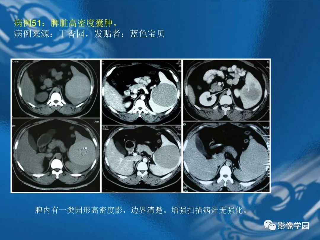 【PPT】脾脏病变大汇集
