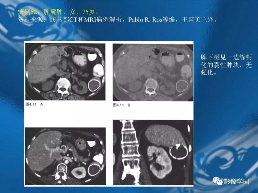 【PPT】脾脏病变大汇集