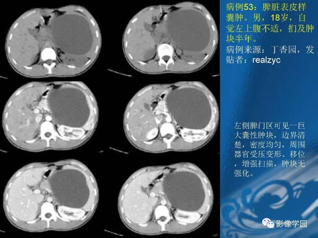 【PPT】脾脏病变大汇集